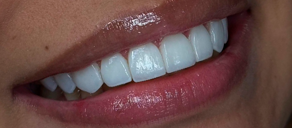 Mentoria Facetas