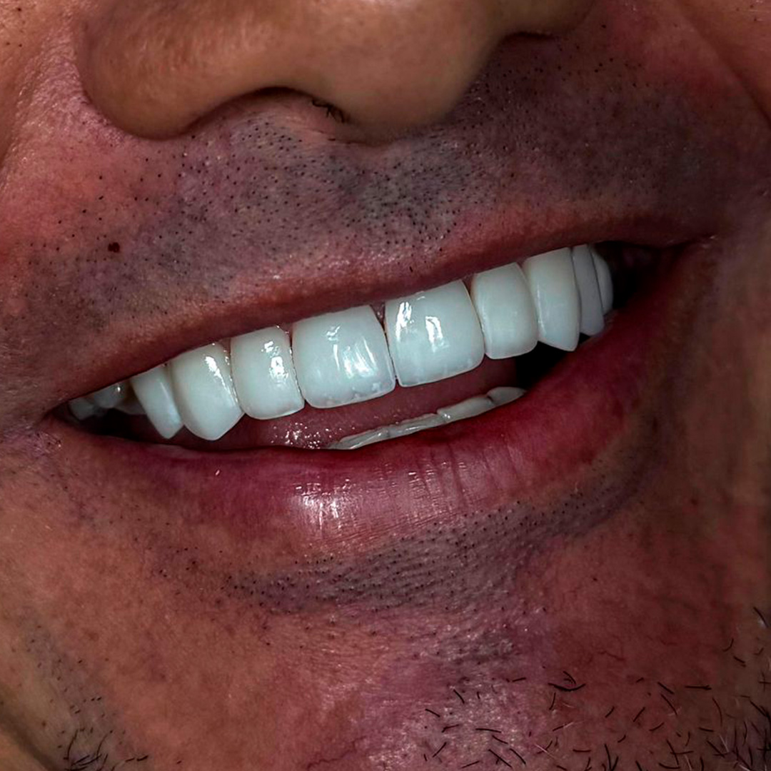 Facetas em Resina