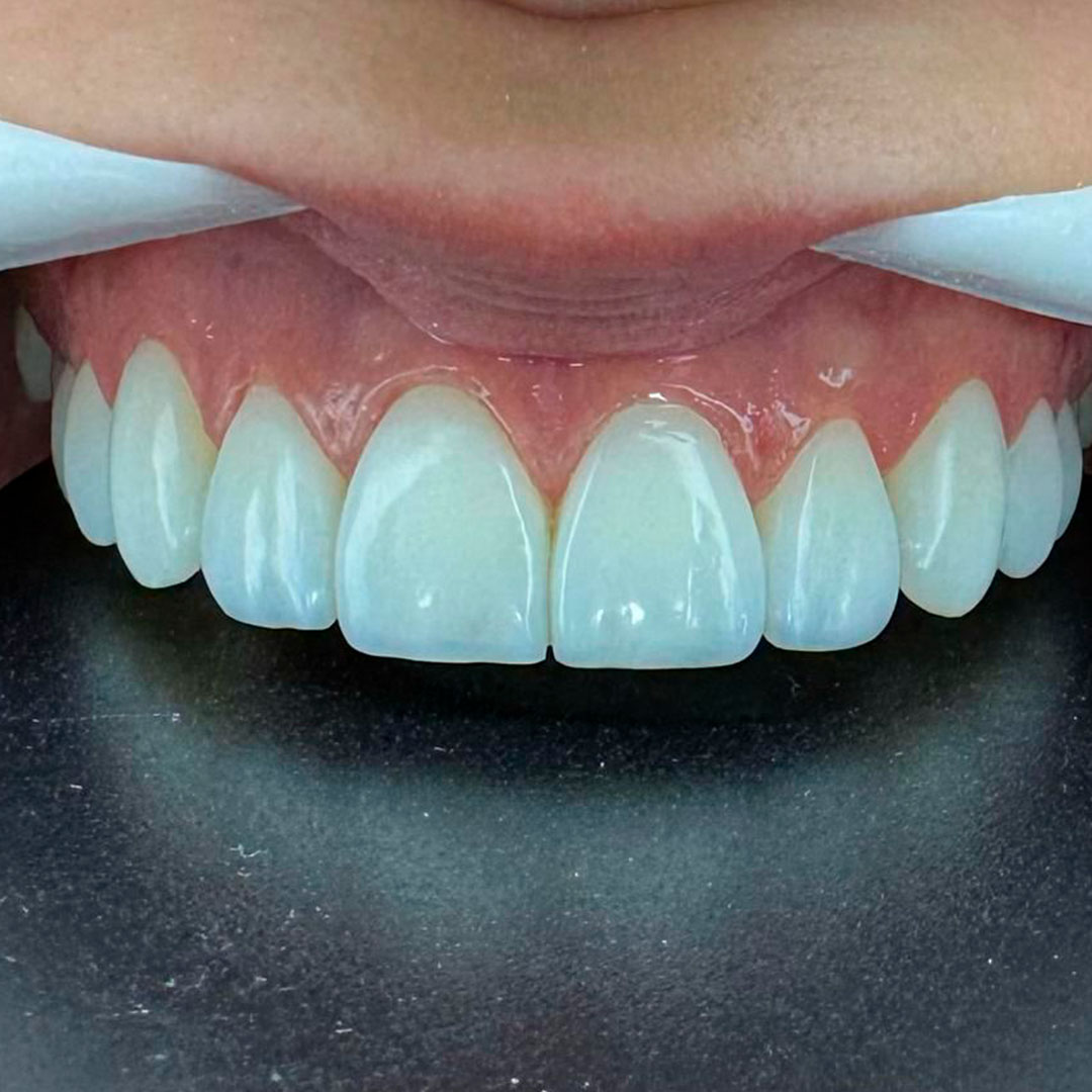 Facetas em Resina