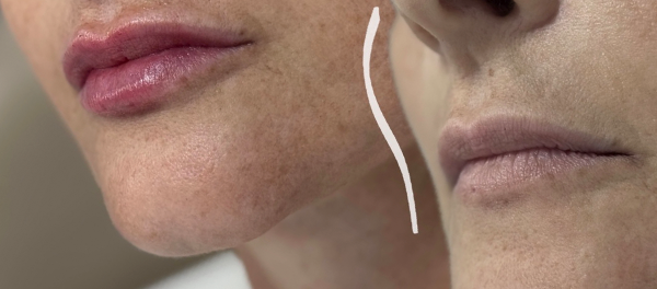 Preenchimento Labial