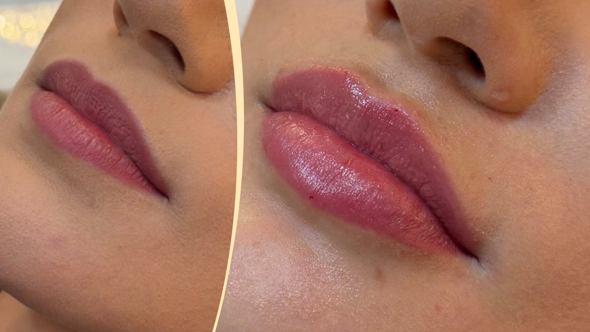 Preenchimento Labial Premium